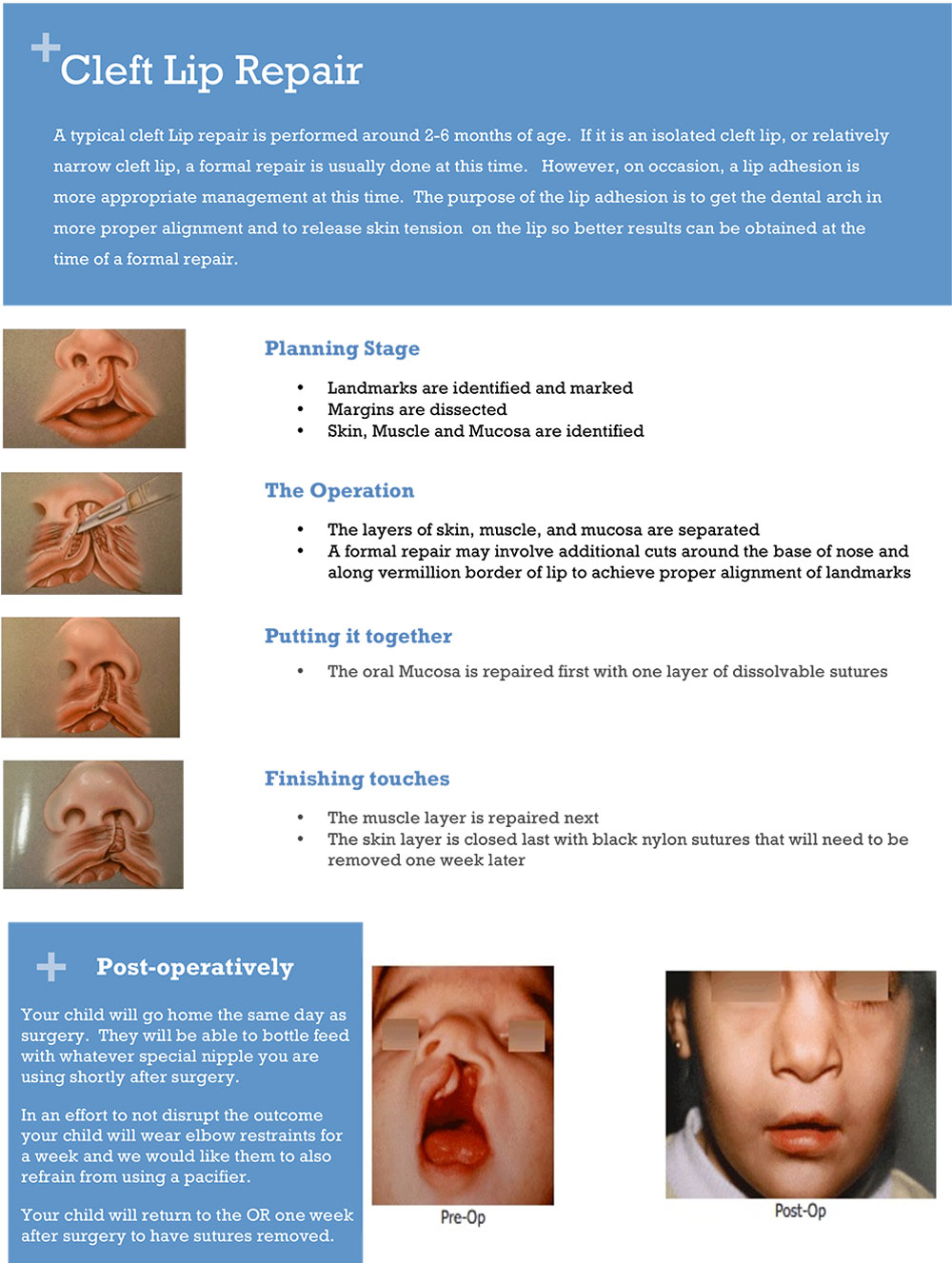 Cleft Lip Repair