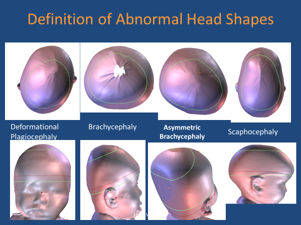 abnormal head shapes
