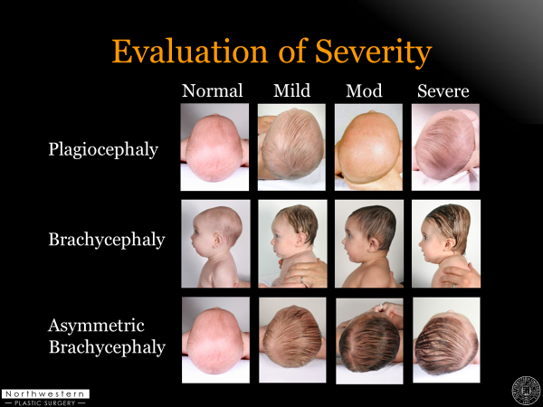 evaluation of severity