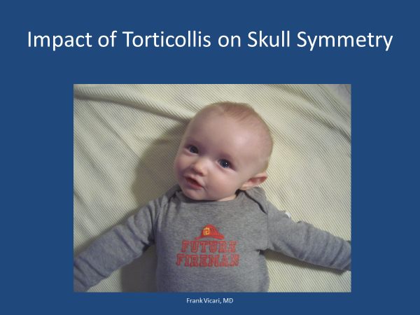 impact of torticollis