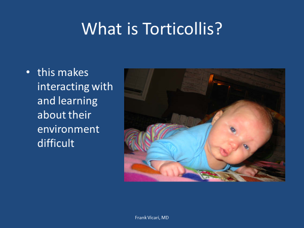 torticollis
